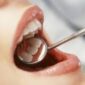 Muelas del juicio: cirugía oral y extracción