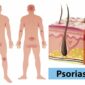 Los pacientes con psoriasis utilizan con frecuencia terapias complementarias o alternativas para tratar sus síntomas
